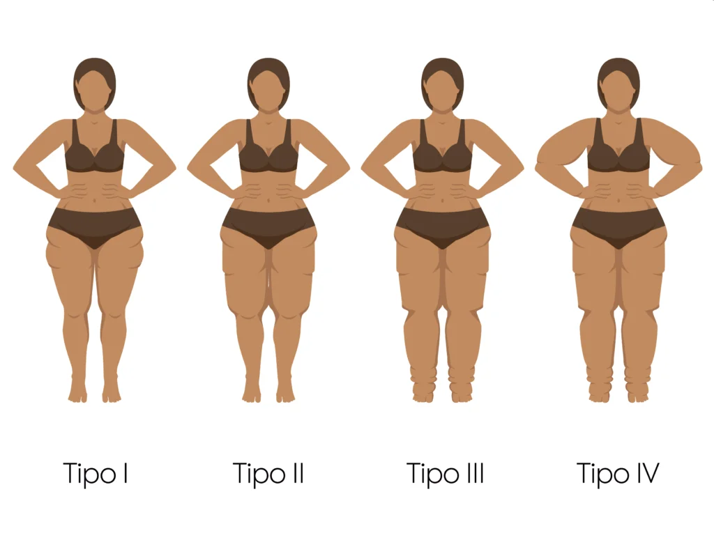 Os 4 estágios do lipedema — Tipo I, II, III e IV, ilustração comparativa